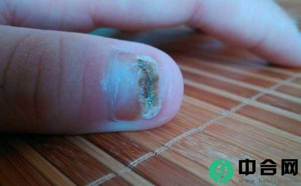 脚趾甲变厚变黄有哪些原因？灰指甲该怎么预防？(1)