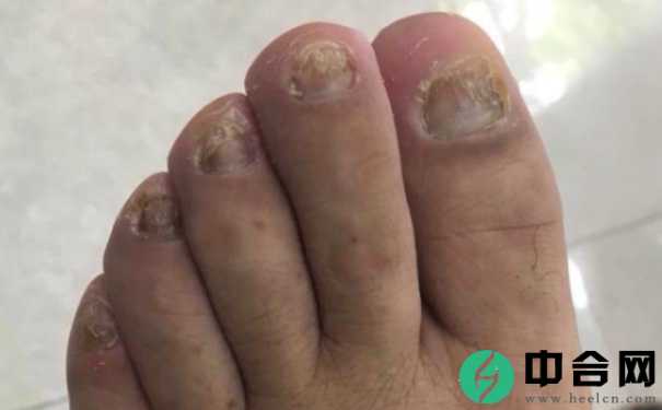 灰指甲的初期症状是什么？什么药治灰指甲最好？(1)